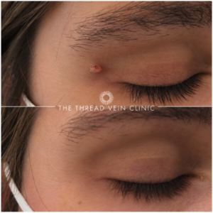 Skin Tag Removal London & Kent
