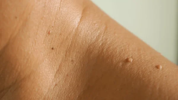 Are Skin Tags Dangerous? When Should You Be Concerned? | Thread Vein Clinic