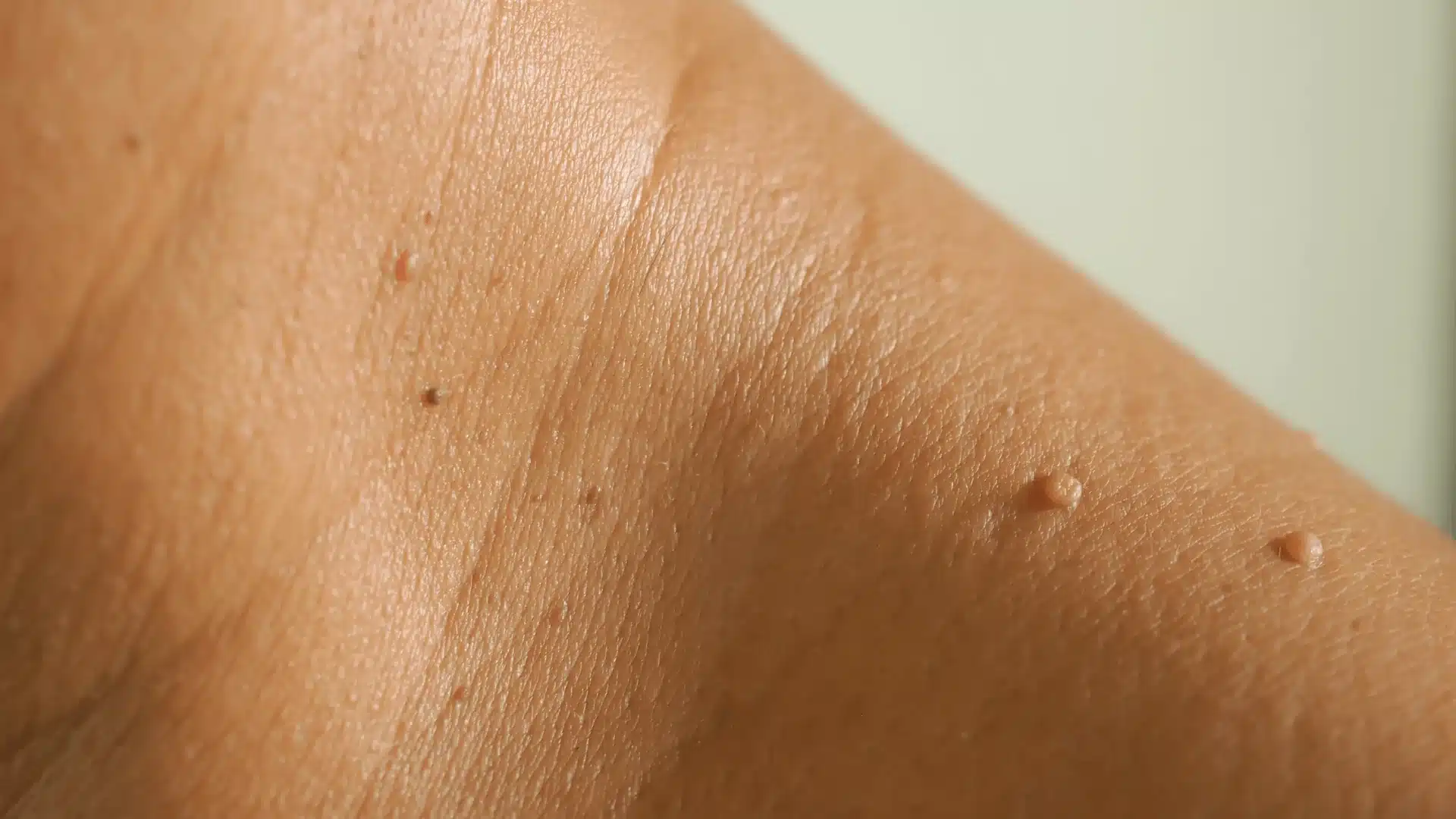 Are Skin Tags Dangerous? Signs You Should Have Them Checked
