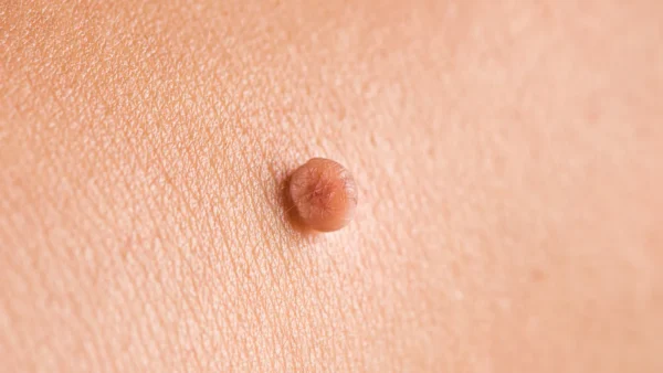 skin tag removal london kent