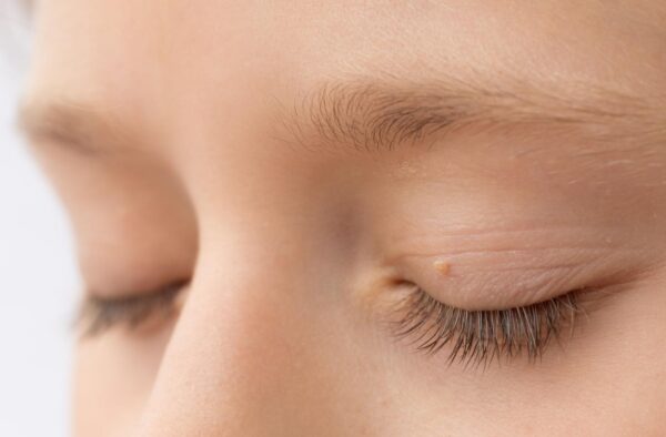 eyelid skin tag removal London & kent